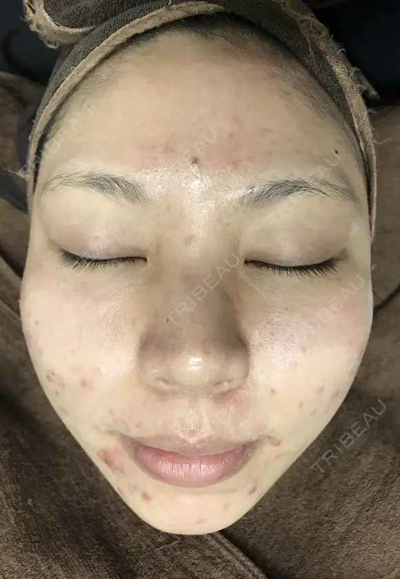 重症ニキビ改善コース　《ヴェルベットスキン5回　マスクピール5回　イソトレチノイン6ヶ月》 before画像 メイン用