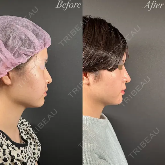 鼻整形－複合－ before画像 メイン用