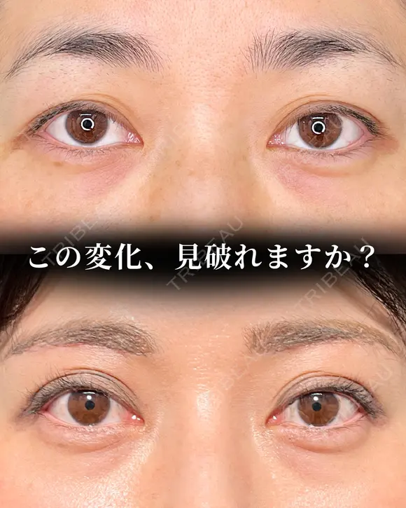 眉下切開 before画像 メイン用