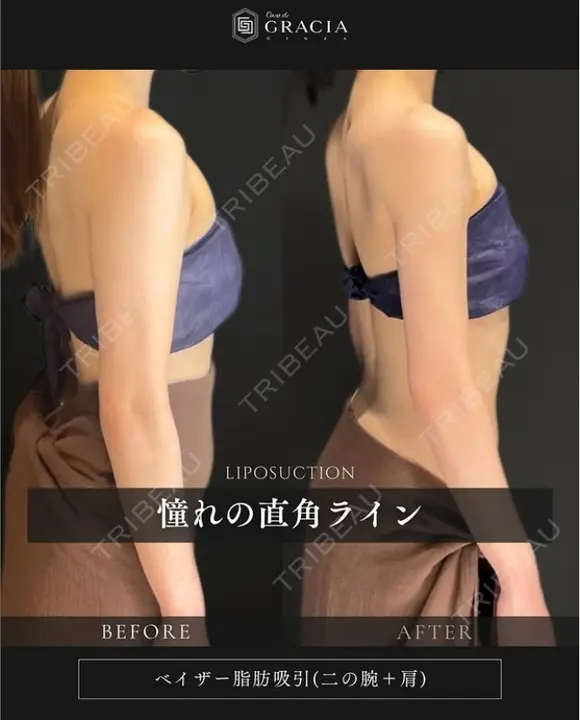 ベイザー二の腕＋肩脂肪吸引 before画像 メイン用