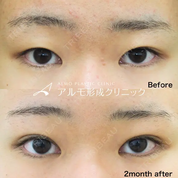 二重埋没法 before画像 メイン用