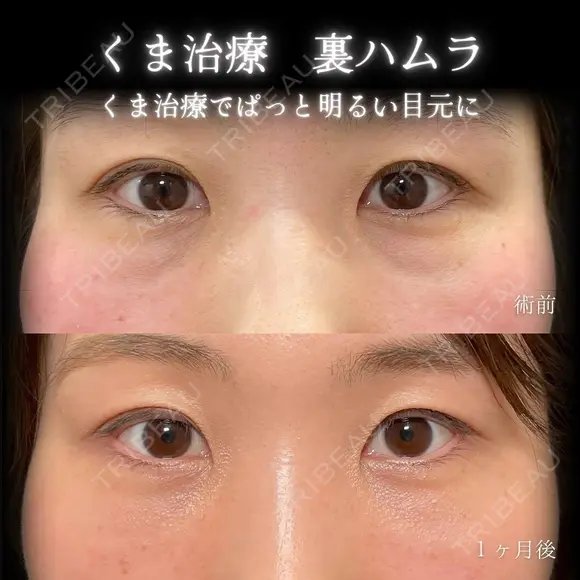 クマ治療　裏ハムラ法 before画像 メイン用
