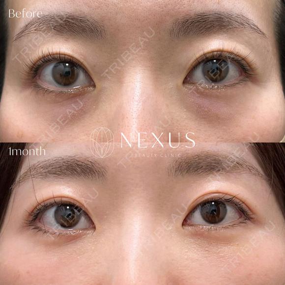 切らない目の下のたるみ取り＋脂肪注入（目の下〜ゴルゴ） after画像 メイン用