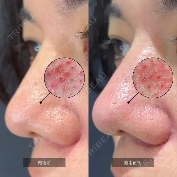 毛穴の大掃除！ハイドラジェントル＋鼻脱毛🐣 after画像 メイン用