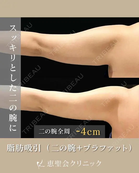 脂肪吸引（二の腕・ブラファット） before画像 メイン用