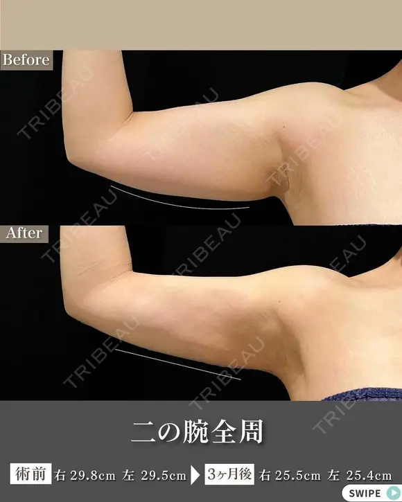 脂肪吸引（二の腕・ブラファット） after画像 メイン用