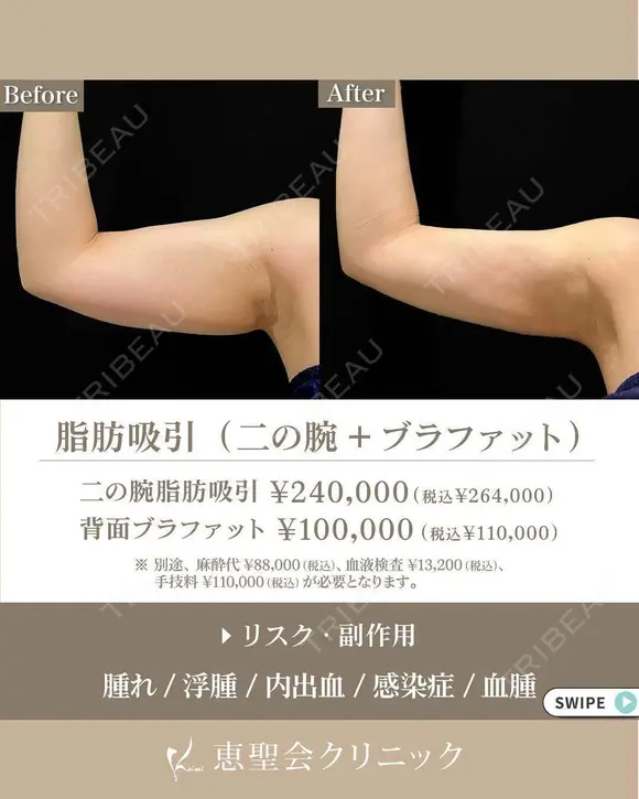 脂肪吸引（二の腕・ブラファット） after画像 メイン用