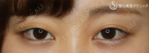 【20代女性・左右差をなくしてぱっちり二重に】マイクロメソッド＋α（１ヶ月後） before画像 メイン用