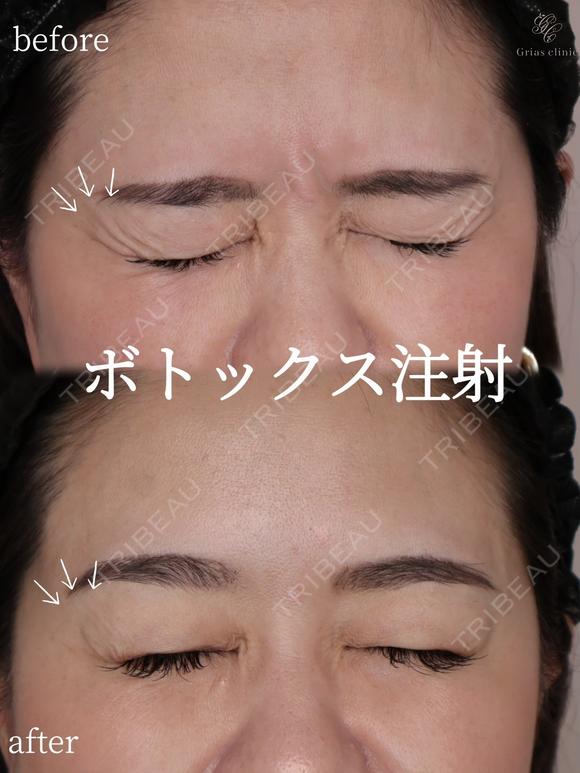 目尻ボトックス after画像 メイン用