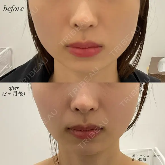 エラボトックス before画像 メイン用