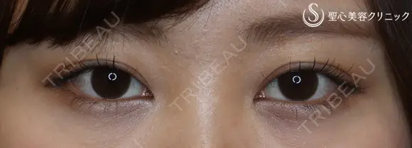 【20代女性・左右差をなくしてぱっちり二重に】マイクロメソッド＋α（１ヶ月後） after画像 メイン用