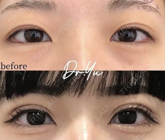 ルラ二重(埋没法) after画像 メイン用