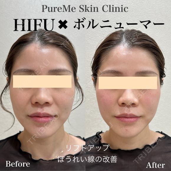 HIFU×ボルニューマー after画像 メイン用