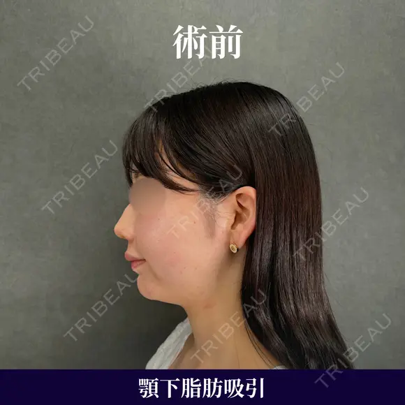 横顔美人は顎下脂肪吸引で作れる✨ 90日後 メイン用