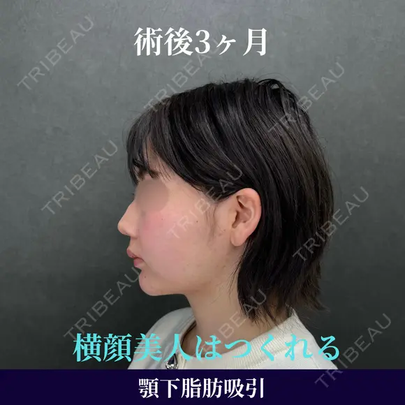 横顔美人は顎下脂肪吸引で作れる✨ 90日後 メイン用