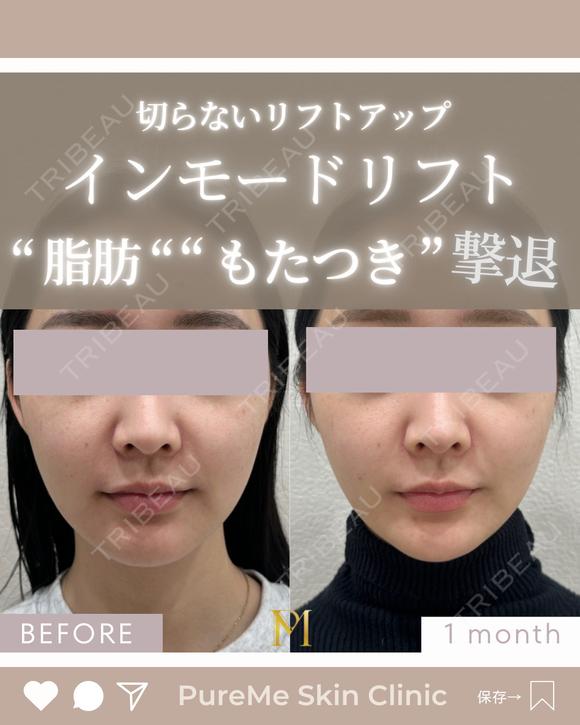 インモードリフト l 切らずにボリュームダウン after画像 メイン用