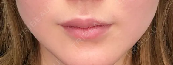 口唇ヒアルロン酸注入 before画像 メイン用