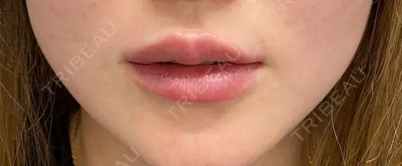 口唇ヒアルロン酸注入 after画像 メイン用