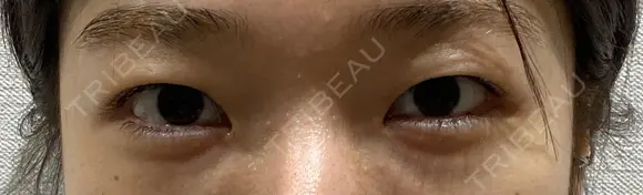 二重埋没法2点留め before画像 メイン用