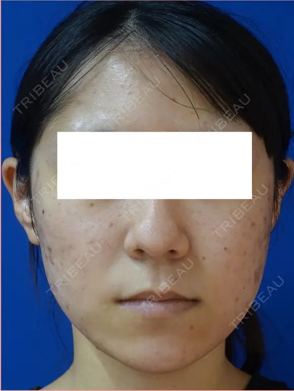 鼻尖縮小+鼻翼縮小（外側） before画像 メイン用