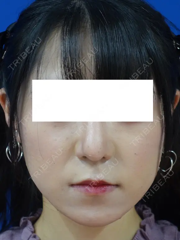 鼻尖縮小+鼻翼縮小（外側） 90日後 メイン用