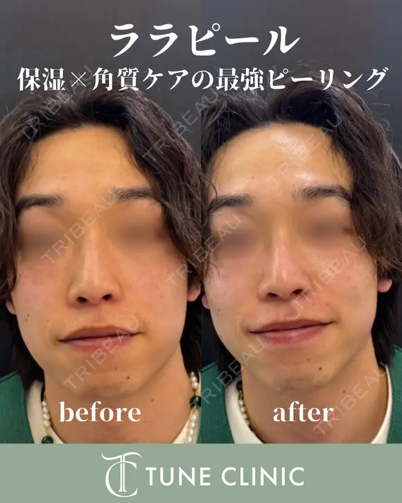 ララピール after画像 メイン用