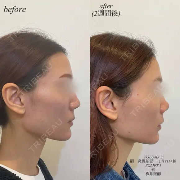 カスタマイズヒアルロン酸注入 after画像 メイン用