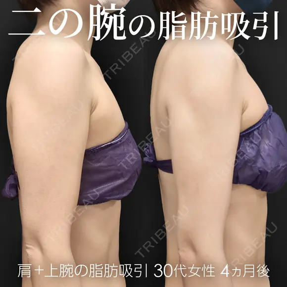 脂肪吸引（二の腕・肩） 120日後 メイン用