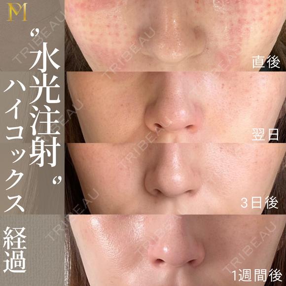 水光注射ハイコックス(ジャルプロクラシック) before画像 メイン用