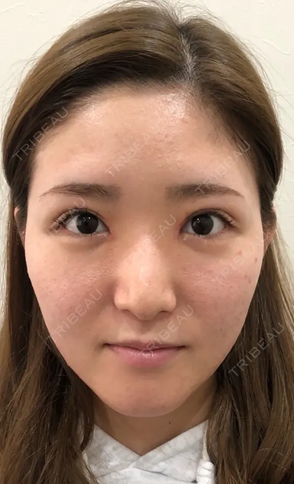 目頭切開（W法）、眼瞼下垂タッキング 10日後 メイン用