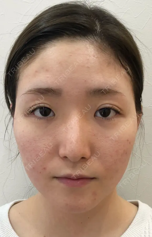 目頭切開（W法）、眼瞼下垂タッキング before画像 メイン用