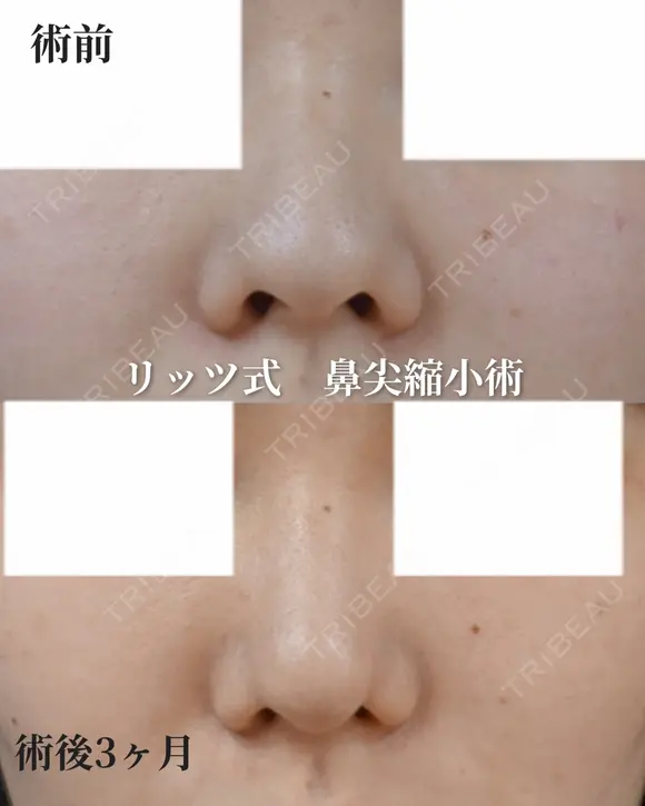 鼻尖縮小 before画像 メイン用