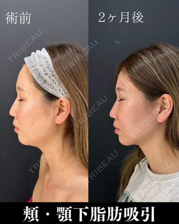 小顔脂肪吸引 after画像 メイン用