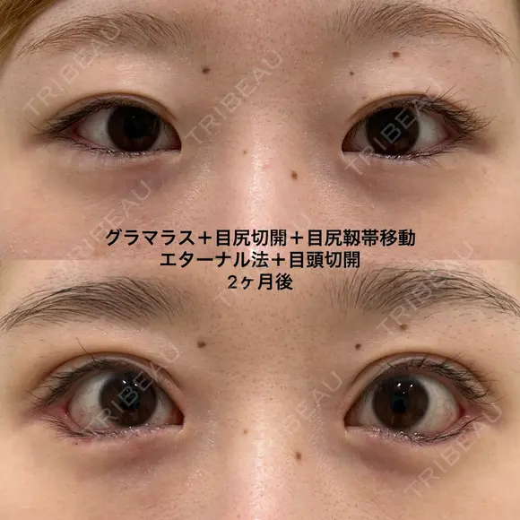 たれ目形成 after画像 メイン用