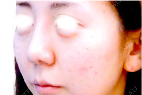 鼻中隔延長術 before画像 メイン用