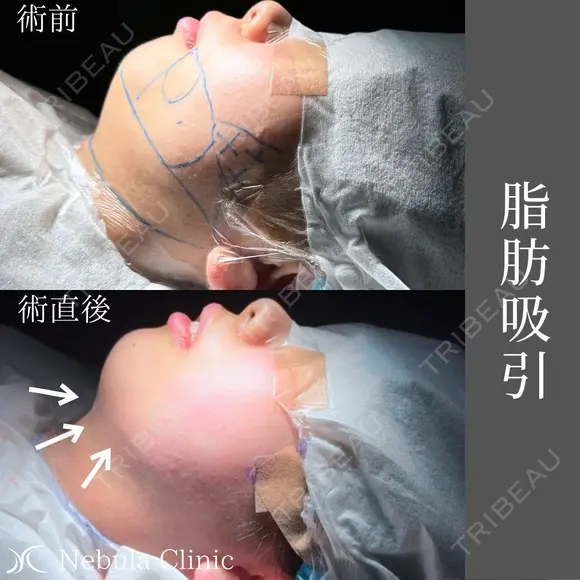 脂肪をなくす🦋！ ネビュラクリニックの脂肪吸引💎 after画像 メイン用