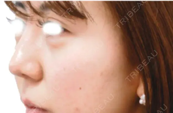 鼻中隔延長術 after画像 メイン用