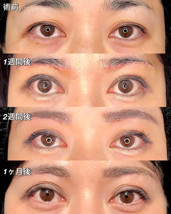 眉下切開 31日後 メイン用