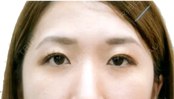 二重まぶた埋没法（竹内式埋没法） after画像 メイン用