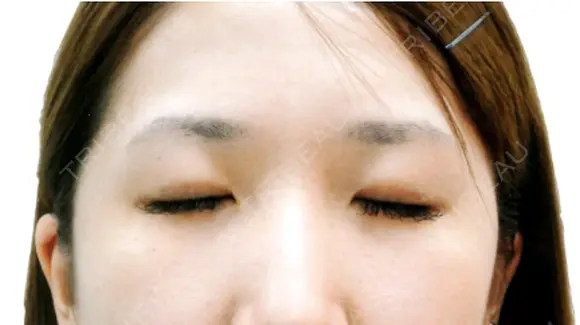 二重まぶた埋没法（竹内式埋没法） after画像 メイン用