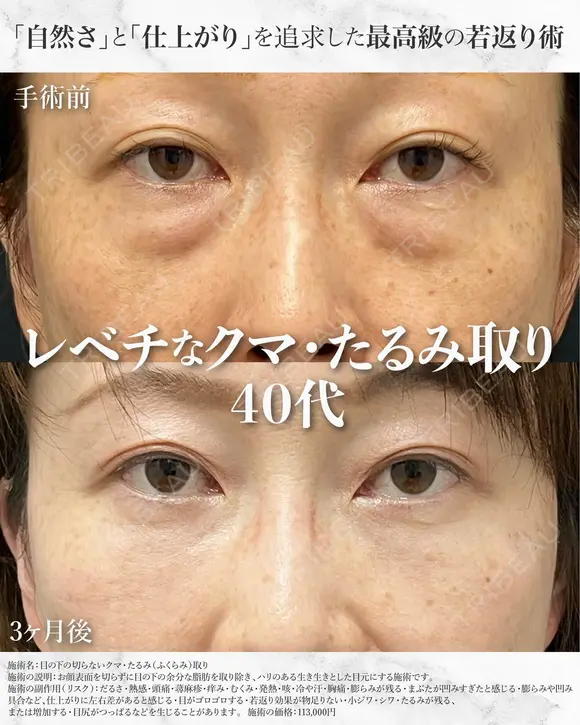 【40代/クマ治療】目の下の切らないクマ取り （脂肪注入併用） 90日後 メイン用