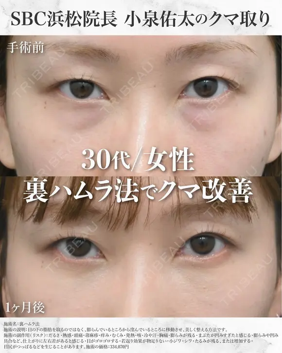 【30代/クマ治療】裏ハムラ法 before画像 メイン用
