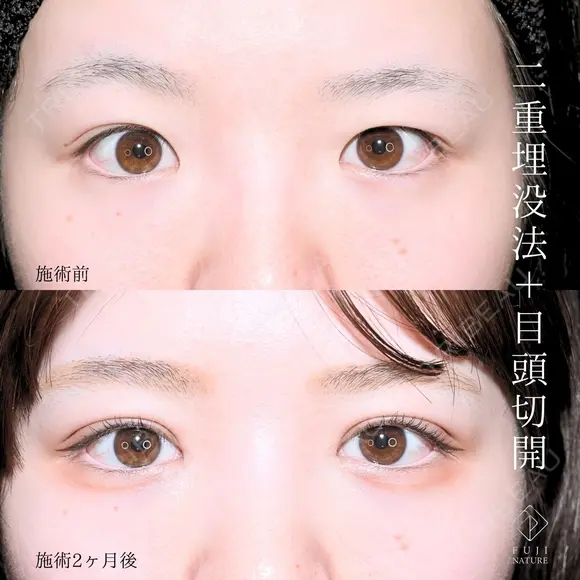 目頭切開+二重埋没法（選べるオーダーメイド） after画像 メイン用