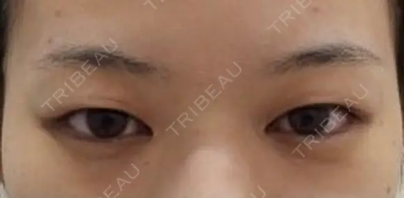 二重埋没 before画像 メイン用