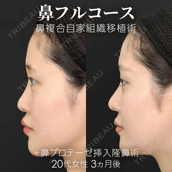 鼻フルコース（鼻複合自家組織移植術）＋鼻プロテーゼ挿入隆鼻術 before画像 メイン用