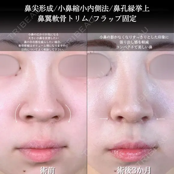 小鼻縮小/鼻翼軟骨トリム/フラップ固定 /鼻尖形成/鼻孔縁挙上 before画像 メイン用
