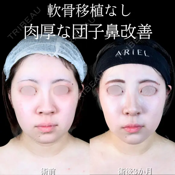 小鼻縮小/鼻翼軟骨トリム/フラップ固定 /鼻尖形成/鼻孔縁挙上 90日後 メイン用