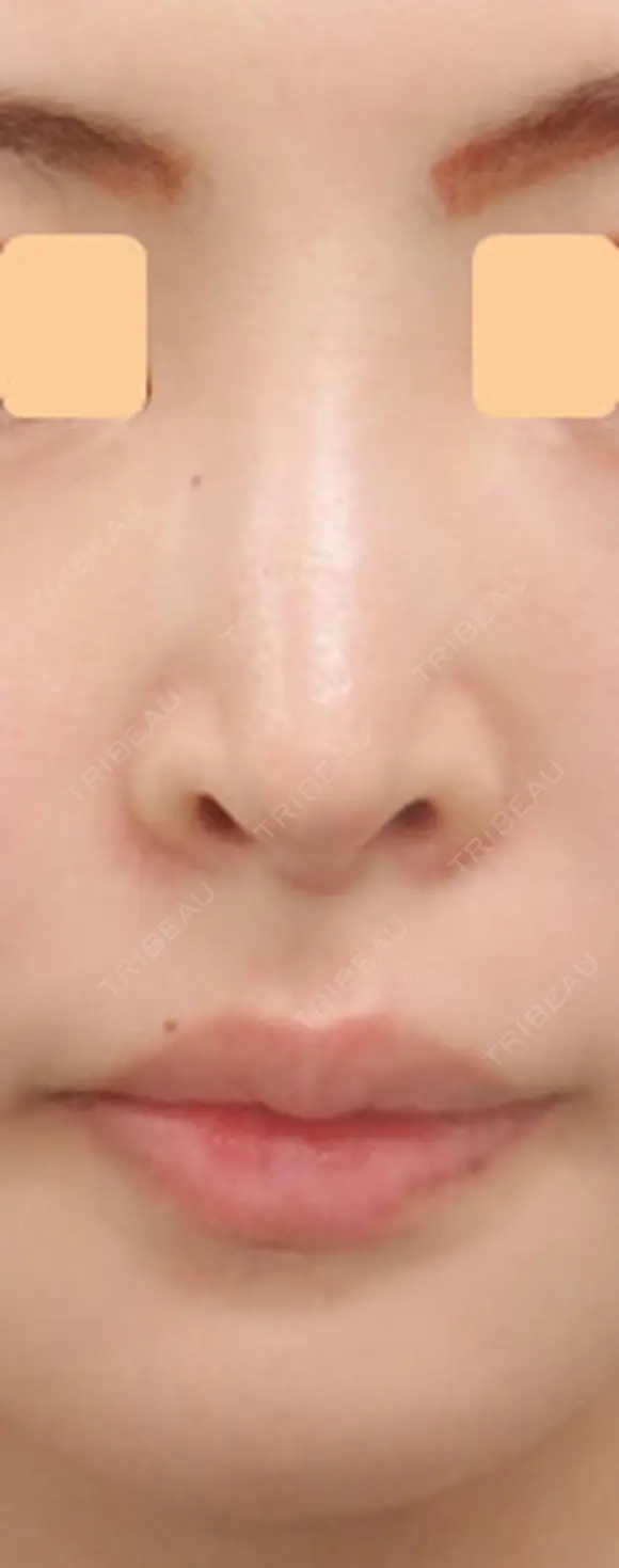 人工真皮Sure Derm挿入矢印鼻･魔女鼻改善術 before画像 メイン用
