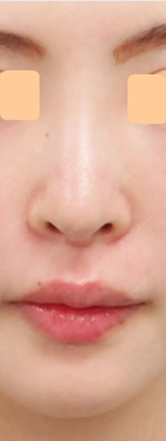 人工真皮Sure Derm挿入矢印鼻･魔女鼻改善術 after画像 メイン用