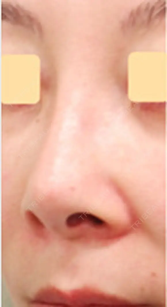 人工真皮SureDerm挿入隆鼻術 before画像 メイン用